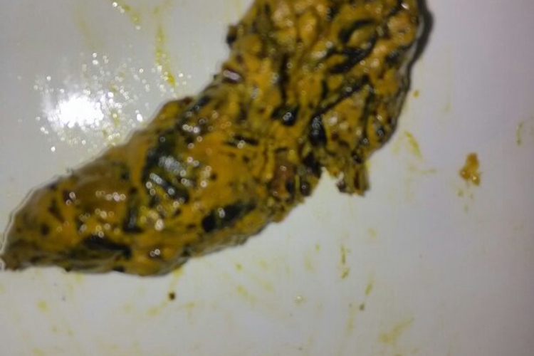 大便带有黑色皮状图