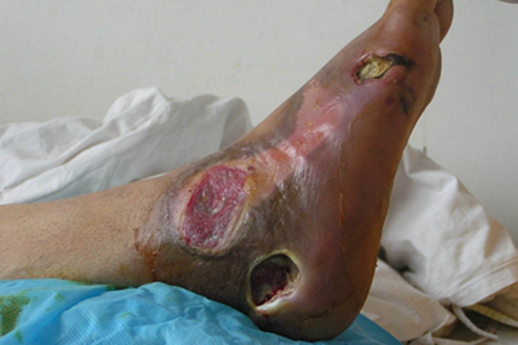 炭疽病脚部症状图