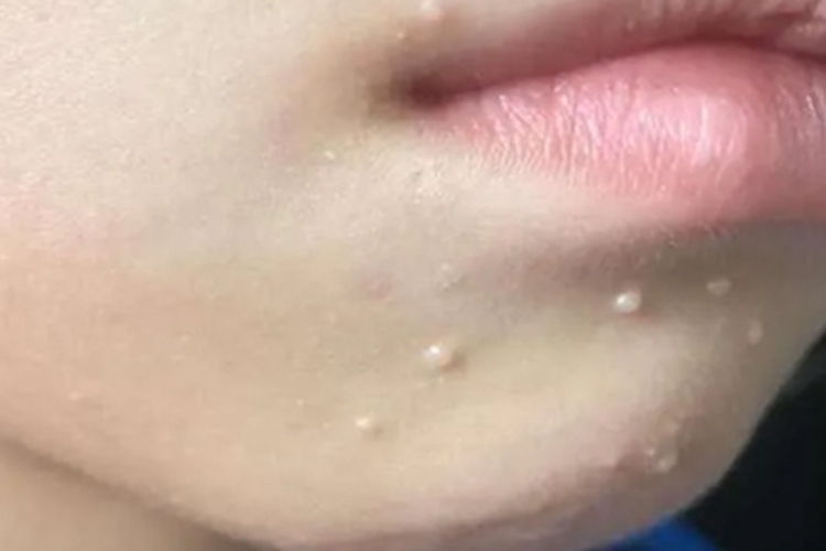 扁平疣脸上长小米粒疙瘩图 扁平疣脸上长小米粒疙瘩图
