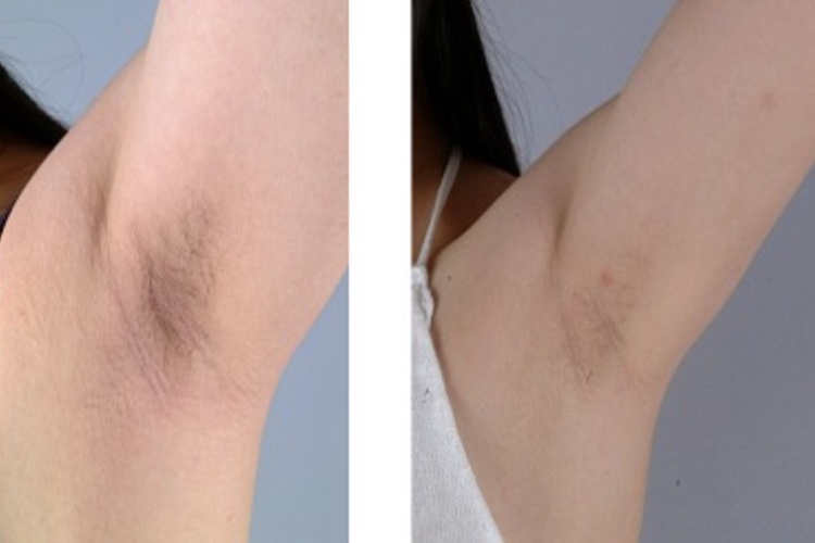 腋下脱毛对比图