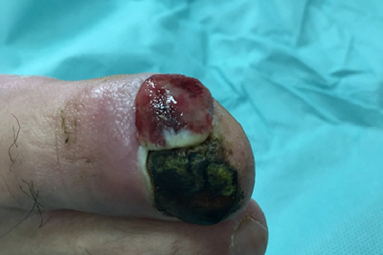 毛发肉芽肿脚趾肉球图 毛发肉芽肿脚趾肉球图