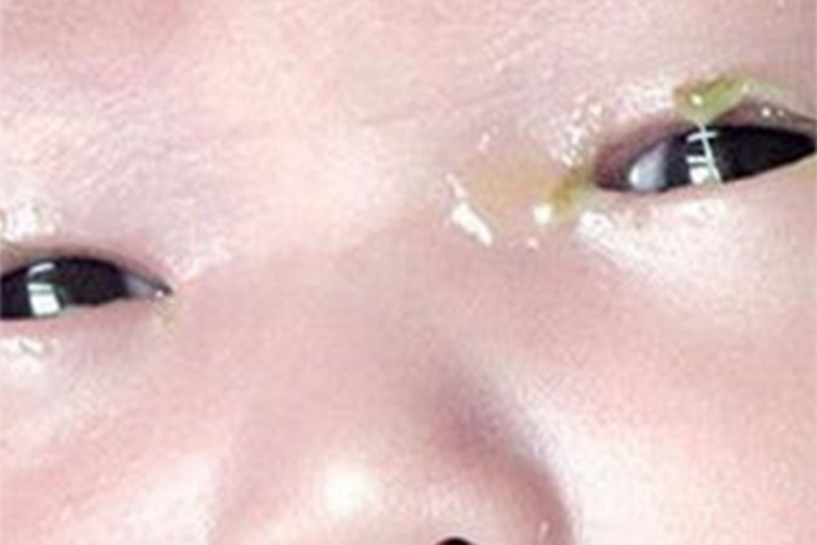 儿童结膜炎眼部化脓图