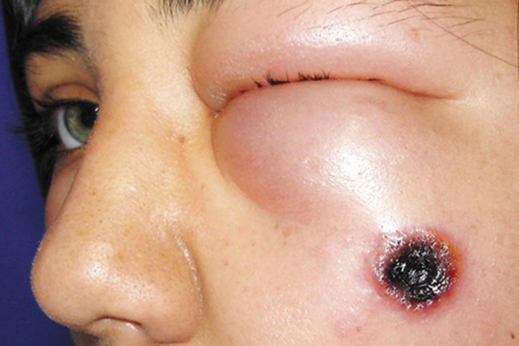 皮肤炭疽眼周肿图