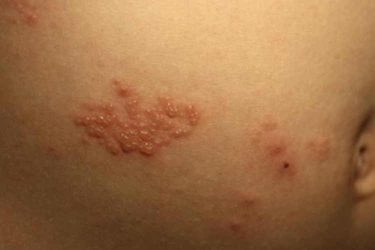 妊娠疱疹小水疱图