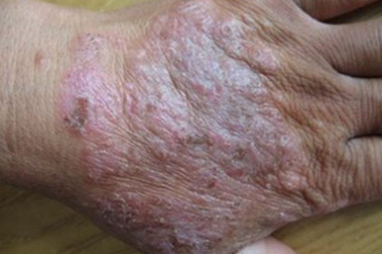 全身性瘙痒症手背皮肤粗糙图