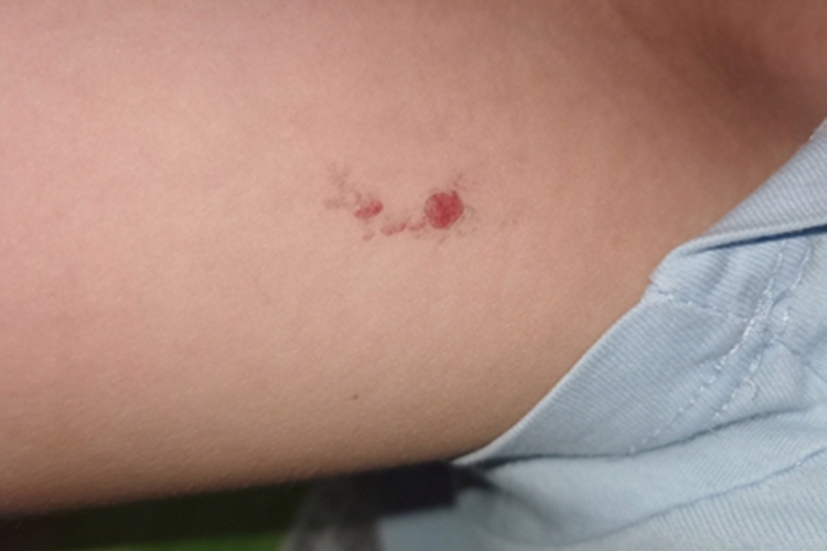 樱桃状血管瘤红斑图