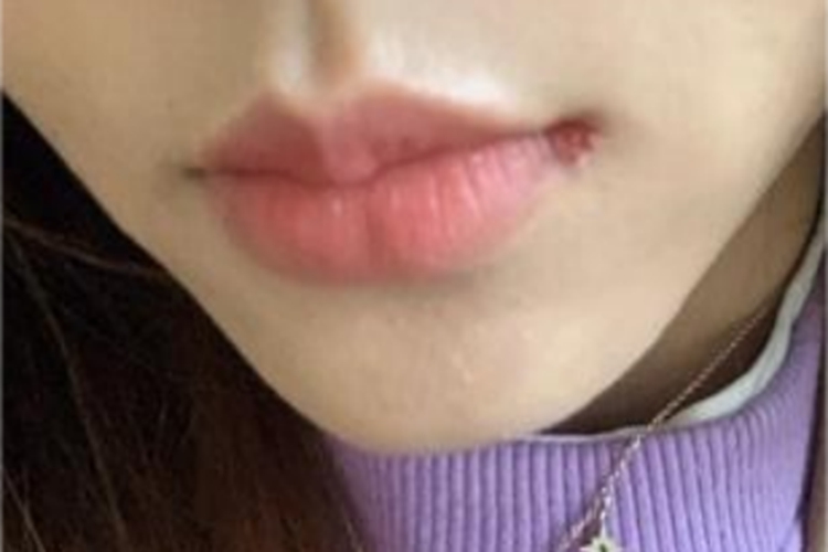 感染性口角炎血痂图 感染性口角炎血痂图