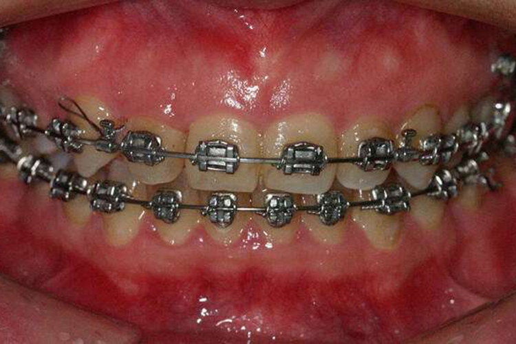 固定矫治器图