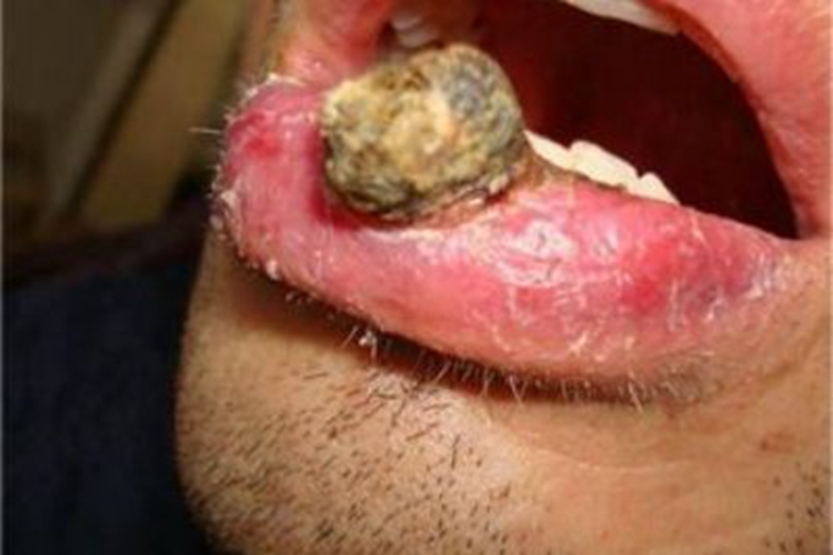 原位鳞状细胞癌嘴唇硬块图 原位鳞状细胞癌嘴唇硬块图