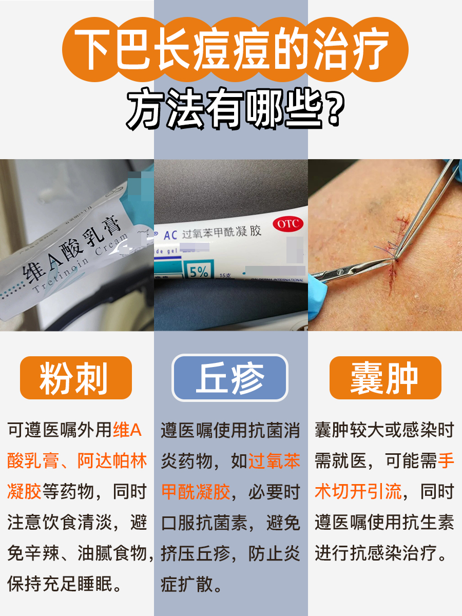 下巴长痘痘,原来是这些原因在作怪!