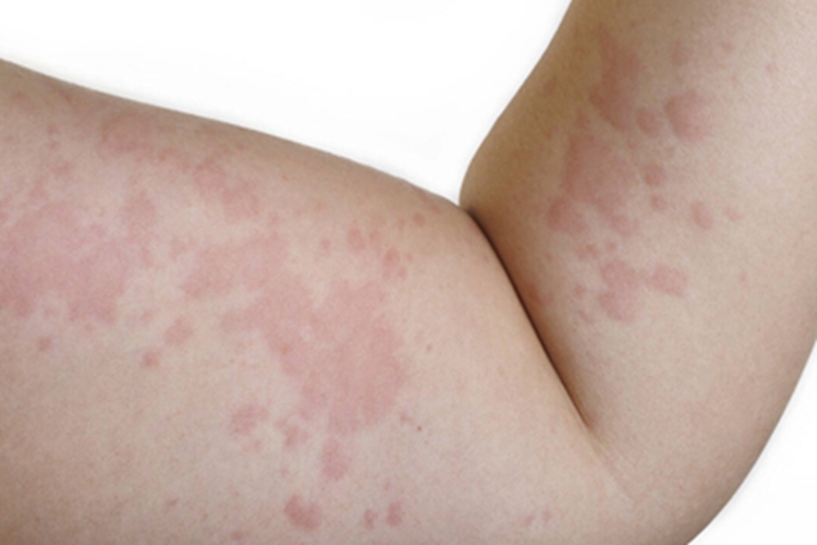 艾滋病急性感染期胳膊症状图 艾滋病急性感染期胳膊症状图