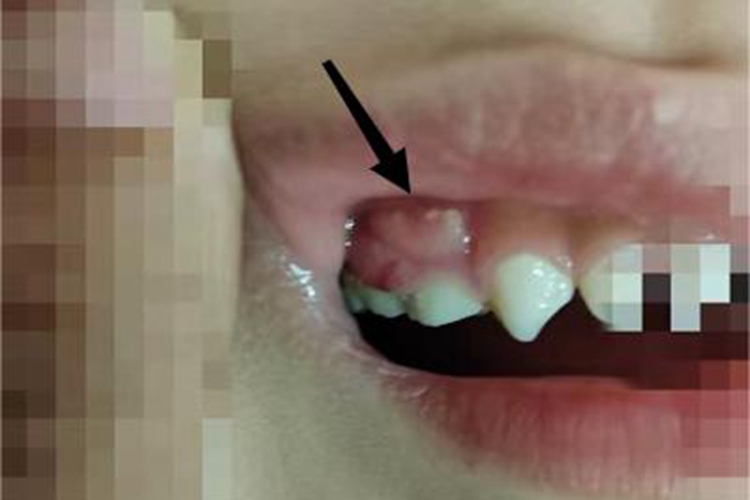 急性化脓性根尖周炎脓包图