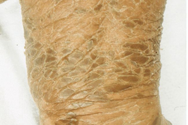 先天性外胚叶发育不良皮肤增厚图