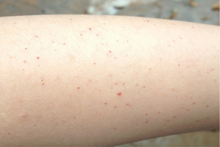 肝癌皮肤出血点图