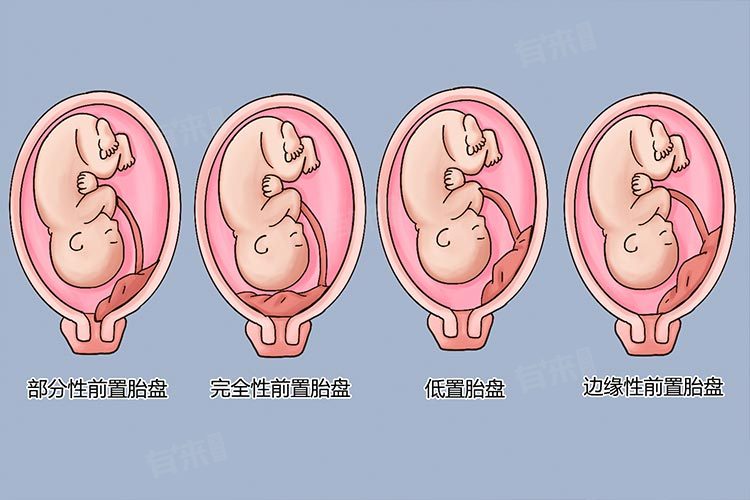 胎盘低置熬过几个月稳定