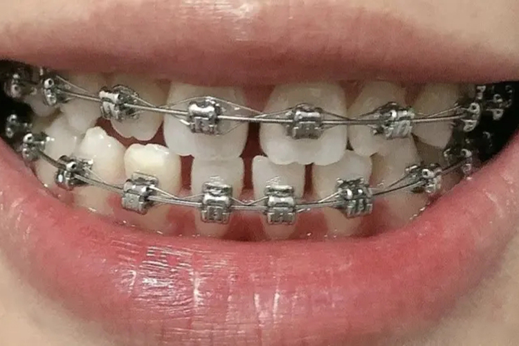 斜面导板矫治器图