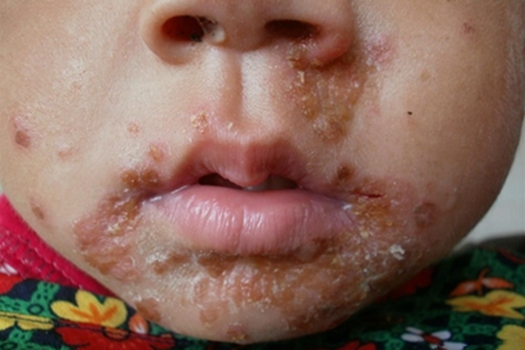 口周皮炎黄痂图 口周皮炎黄痂图