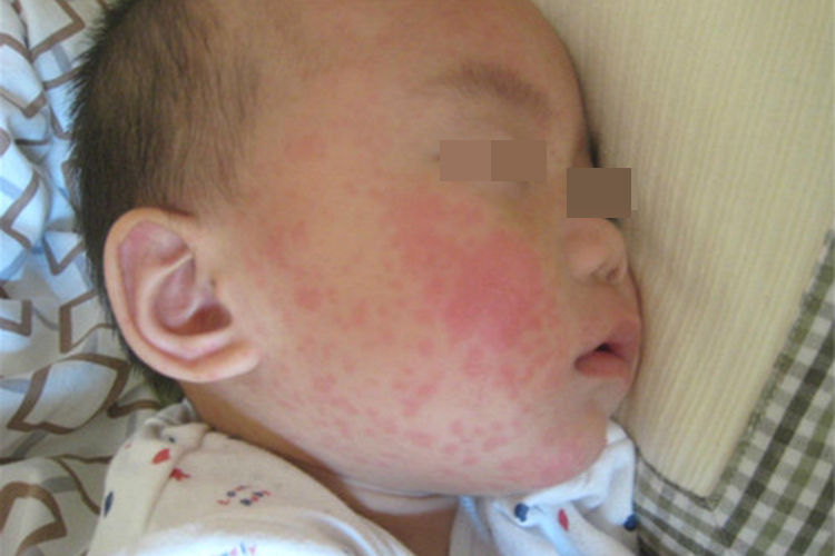 幼儿急疹图 幼儿急疹图