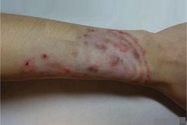 体癣胳膊结痂图 体癣胳膊结痂图