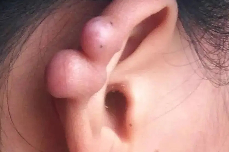 耳骨钉增生图