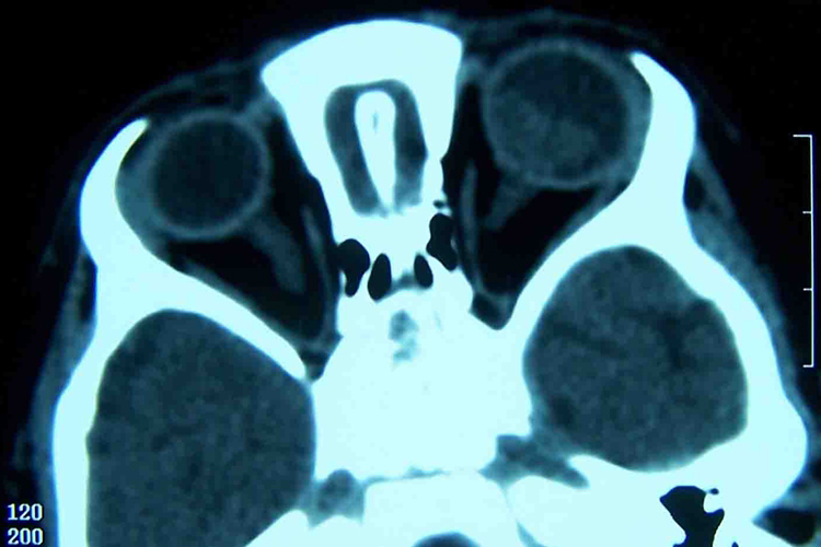 神经母细胞瘤CT图