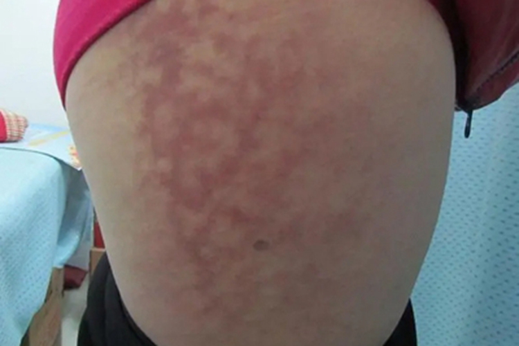 火激红斑大腿红斑图