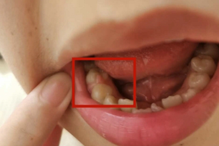 边缘性龈炎牙龈水肿图