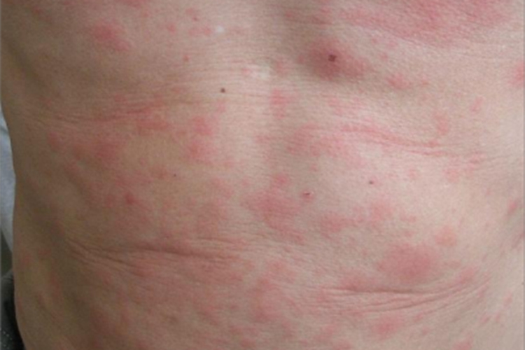 碘疹腹部红斑图