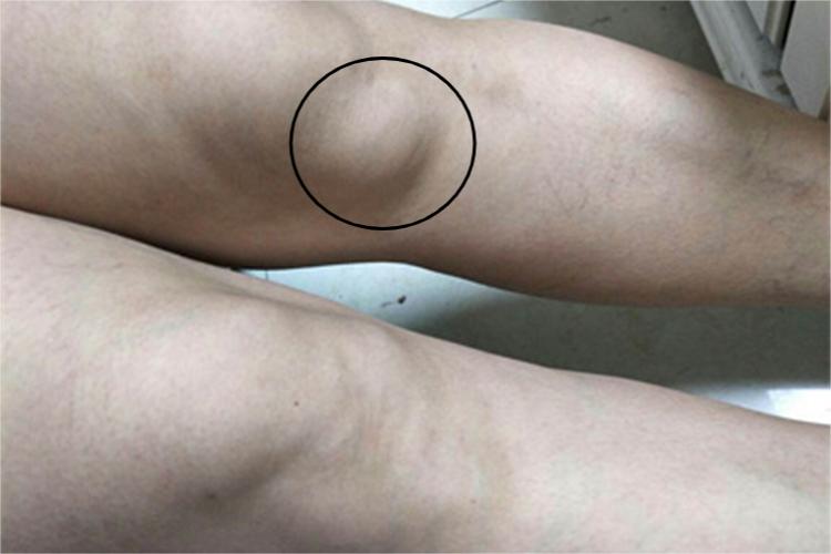 转移性皮肤钙沉着症大包图