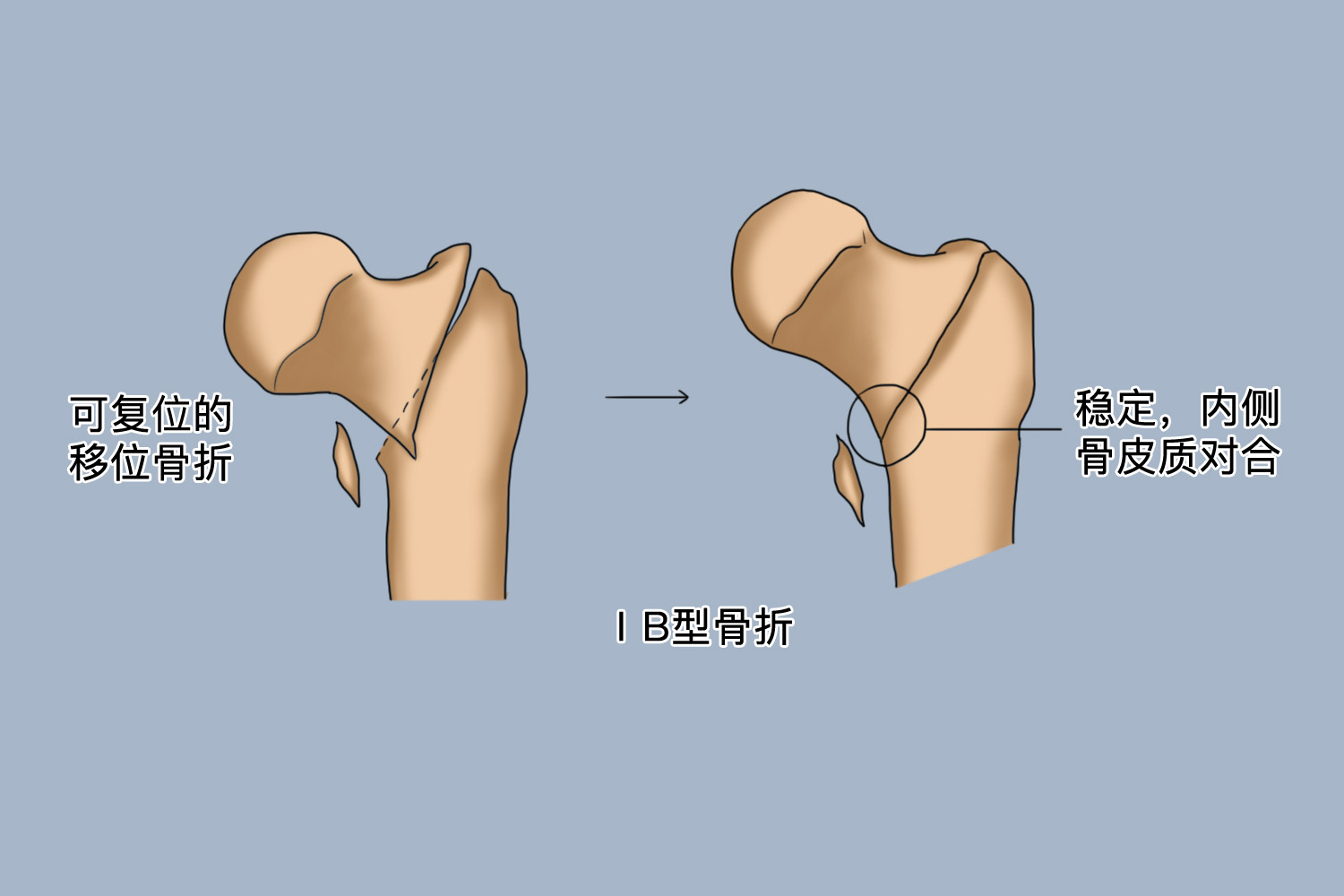 EvansⅠB型骨折图