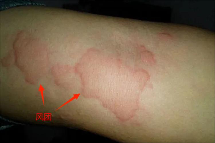 冷接触性荨麻疹图