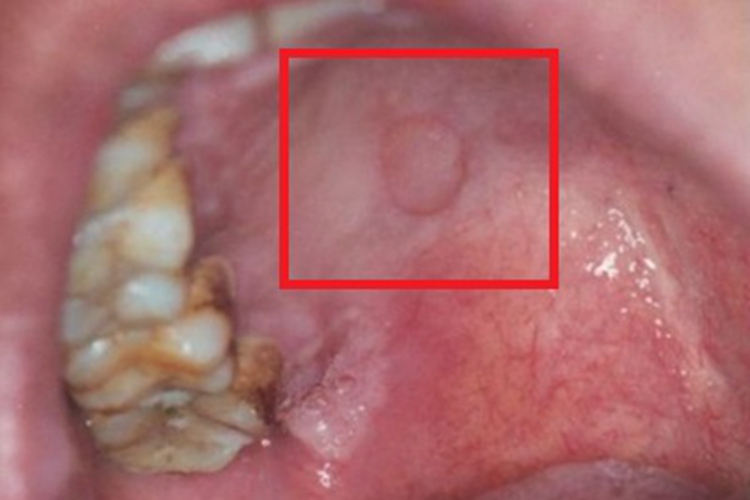女性梅毒口腔白斑图