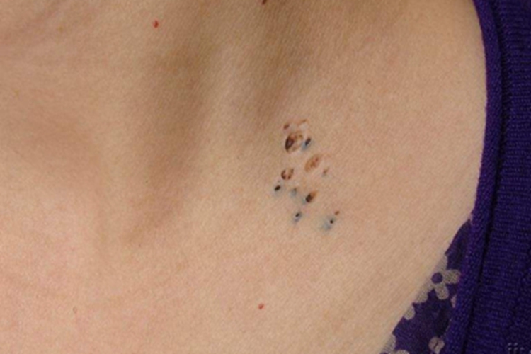 黑头粉刺样痣小坑图