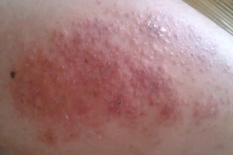 湿疹小疙瘩图