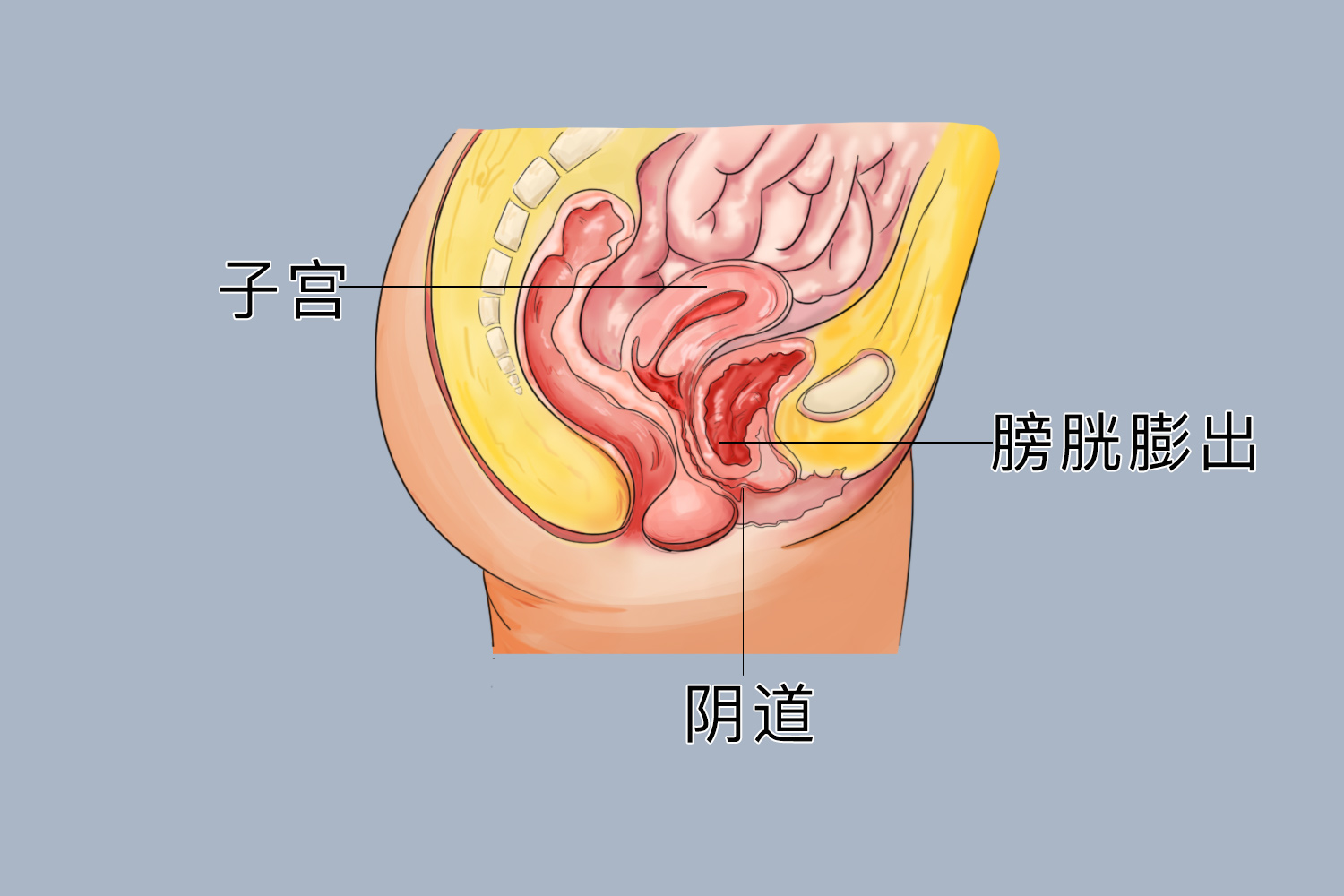 膀胱膨出的症状图片图片