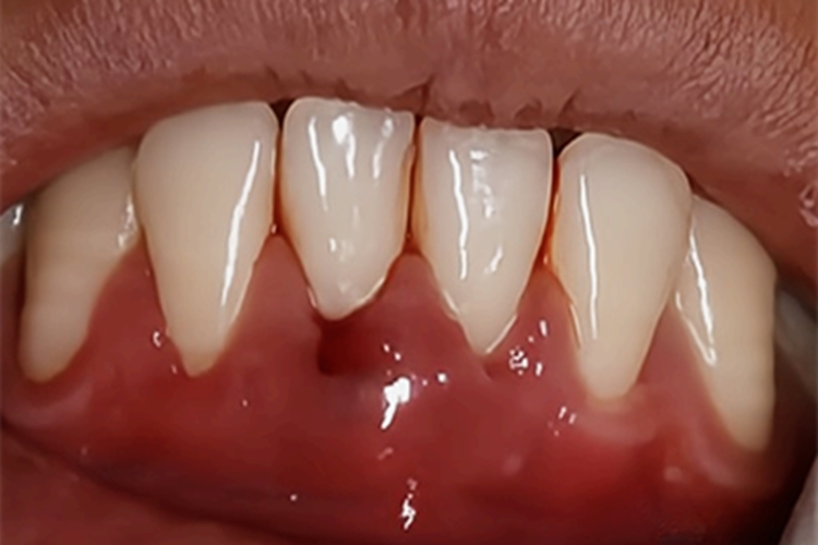 急性牙周脓肿牙龈有红色小疙瘩图