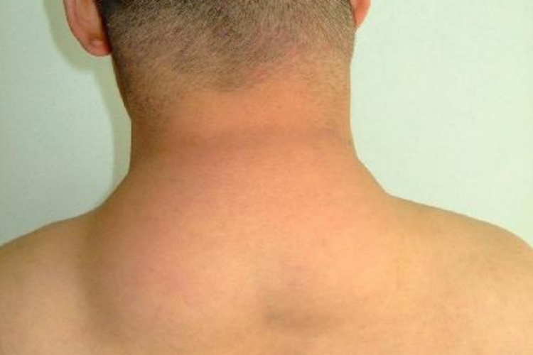 颈部脂肪瘤瘤体增大图