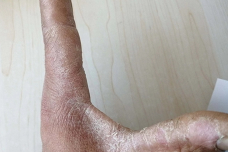 鳞屑角化型手癣手指缝症状图