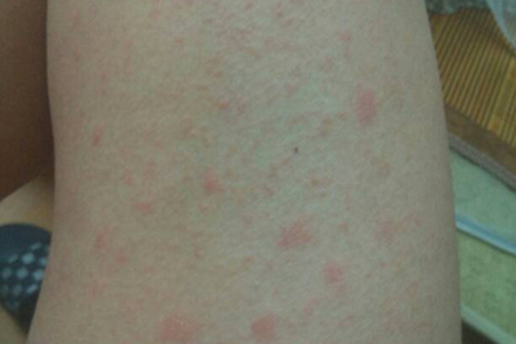 地方性斑疹伤寒大腿斑疹图