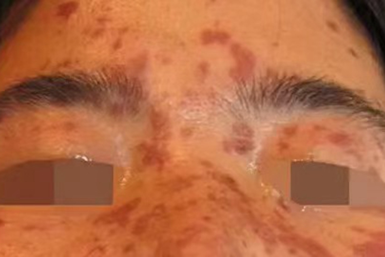 上眼皮药疹图 上眼皮药疹图