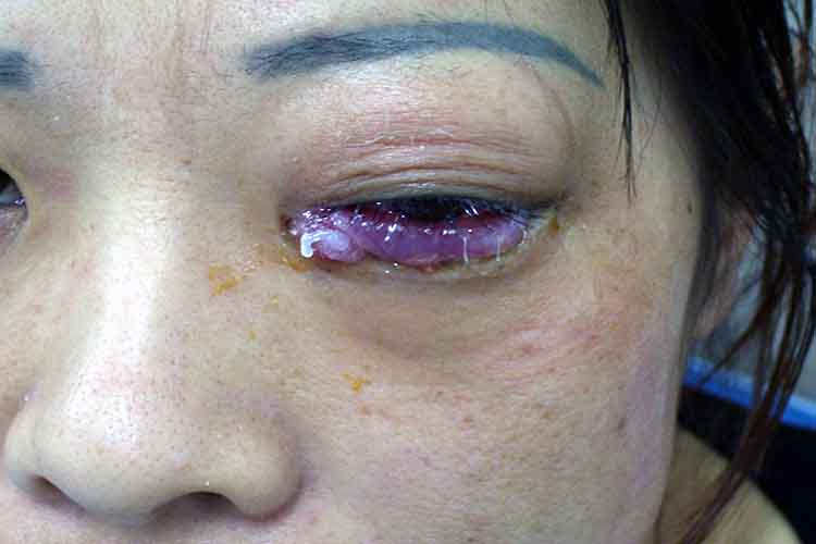 眼睑蜂窝织炎症状图