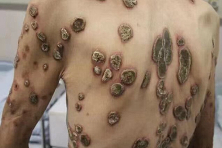 疣状角化不良瘤背部疙瘩图