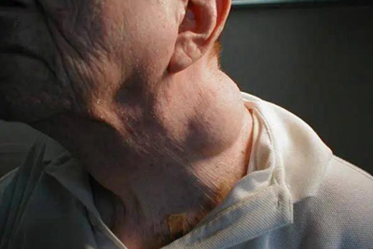 多形性脂肪瘤颈部长肿块图