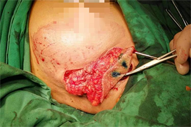 乳腺结节传统手术刀口图 乳腺结节传统手术刀口图