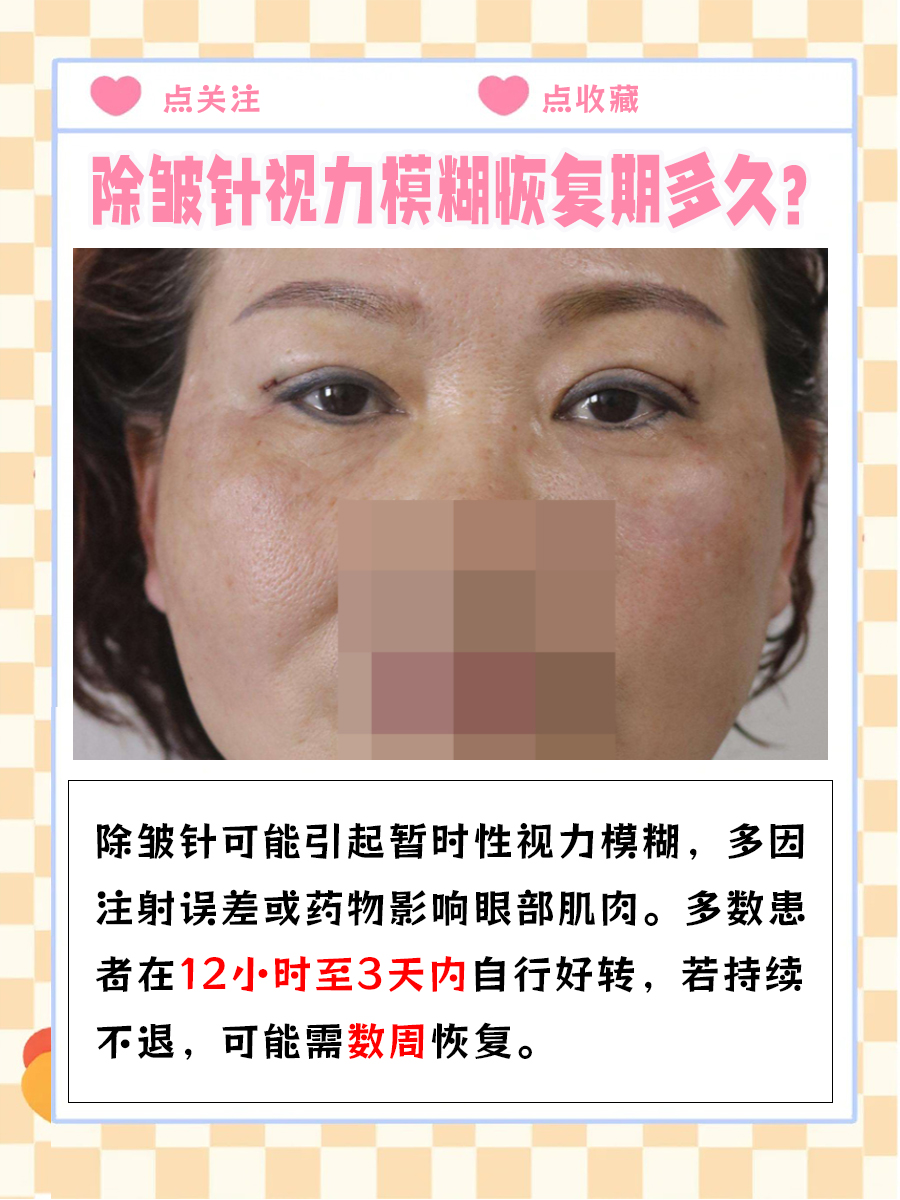 除皱针视力模糊恢复期 ,你知道多久吗?