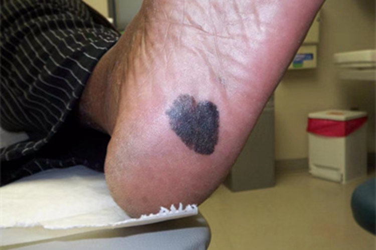 恶性黑色素瘤脚底症状图