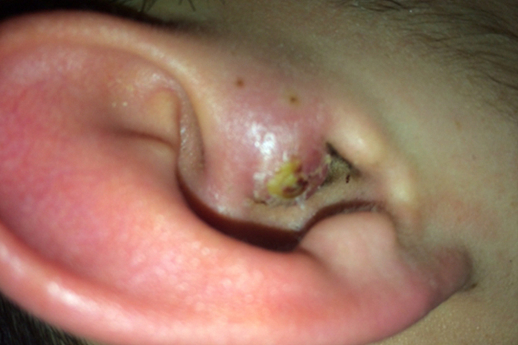 耳朵外耳道疖脓包图