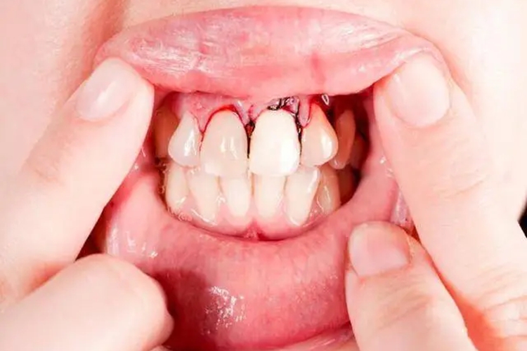 白血病牙龈出血图