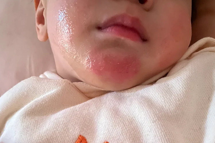 急性接触性皮炎下巴红图 急性接触性皮炎下巴红图