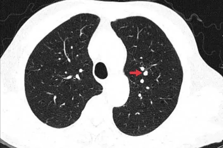 肺结节图